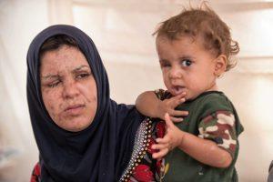 Khadija var sammen med sin mand og tre små børn på vej gennem et minefelt i nattens mulm og mørke på flugt fra IS. Hun havde den etårige Mahmoud i sine arme, da en mineeksplosion forandrede deres liv for altid.